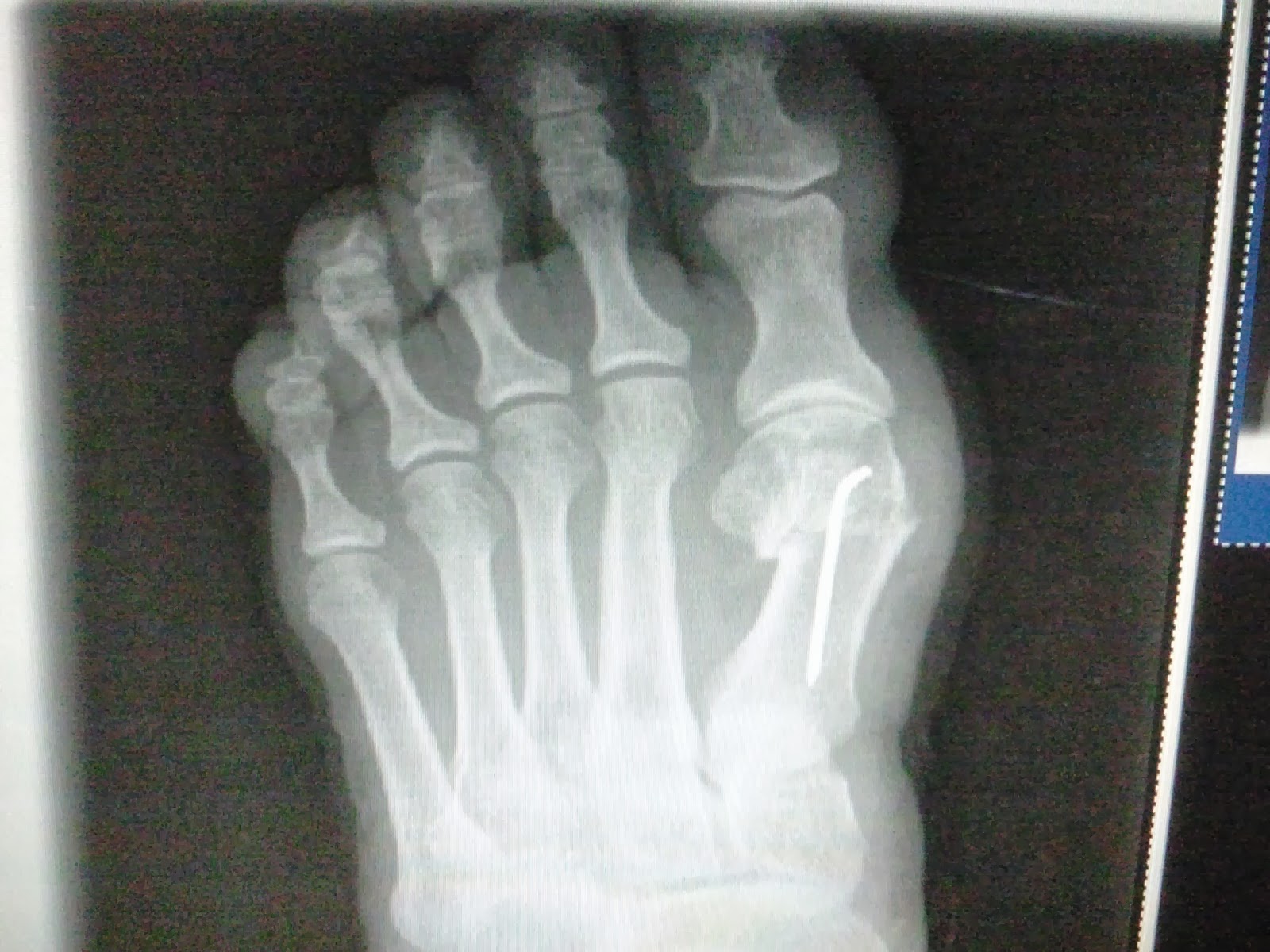 Cirugia de juanetes con tornillos